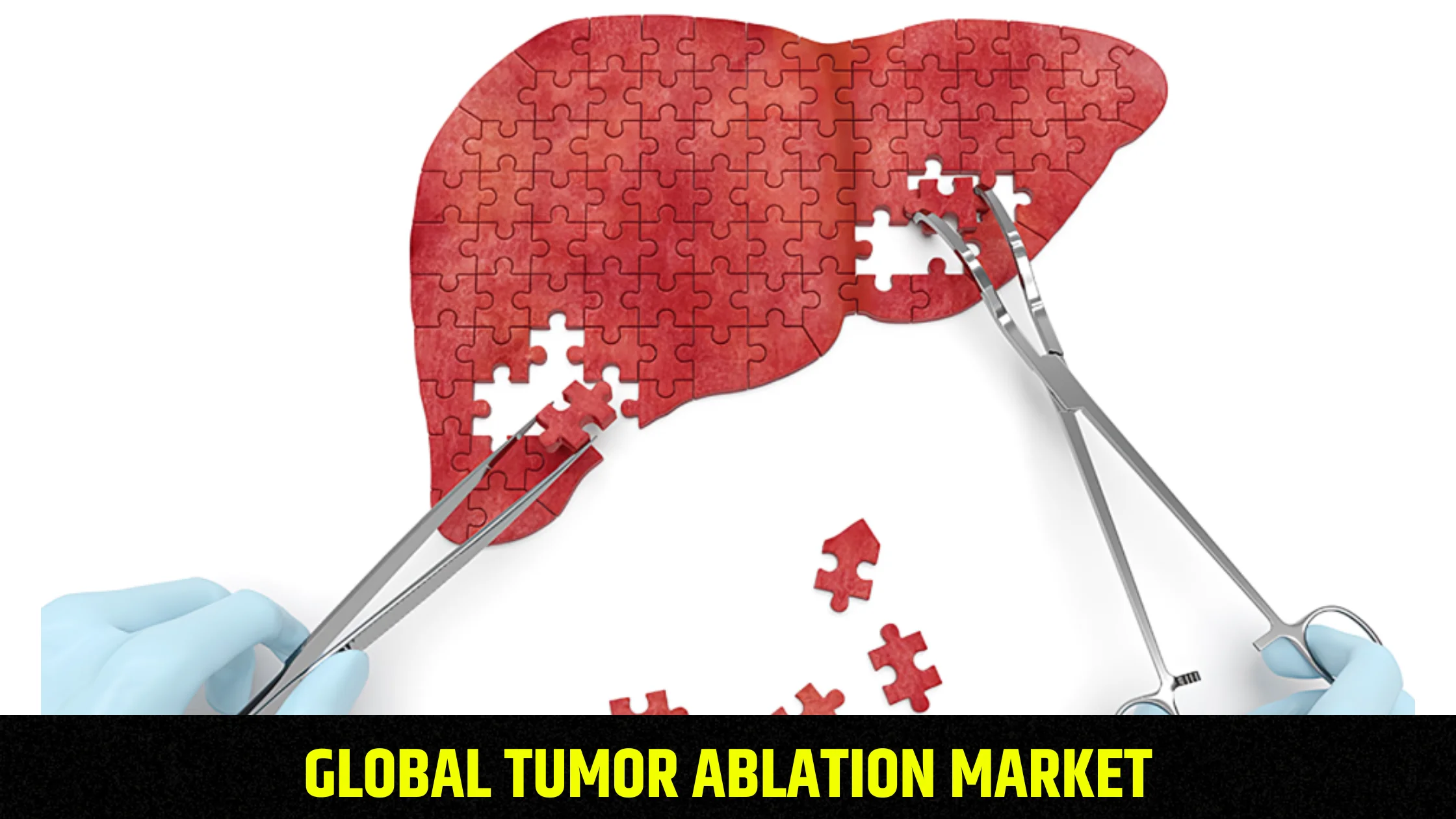 global-tumor-ablation-market